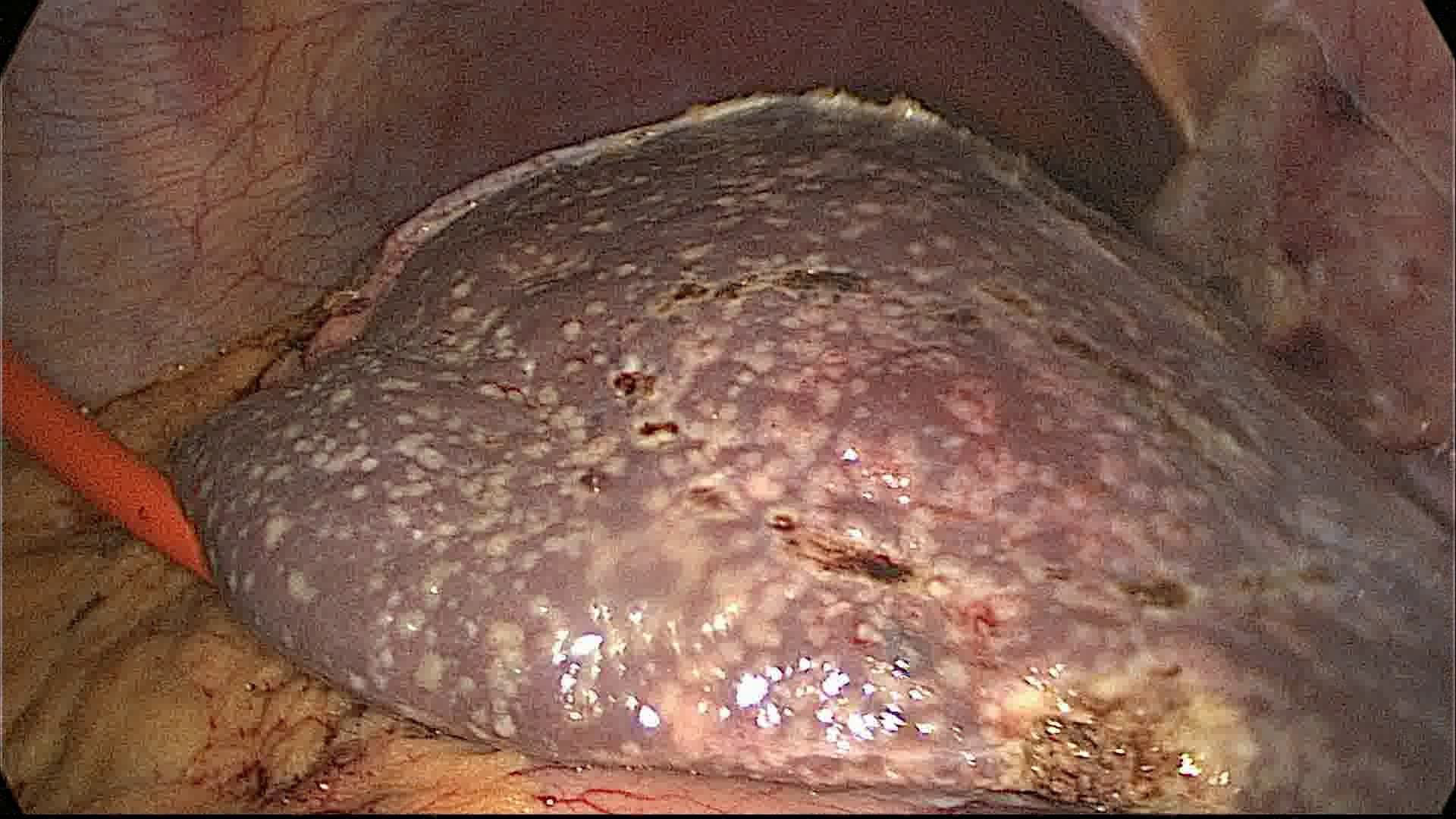腹腔镜背景